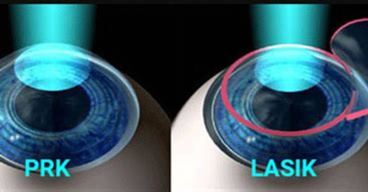 Does Prk Last Longer Than Lasik?
