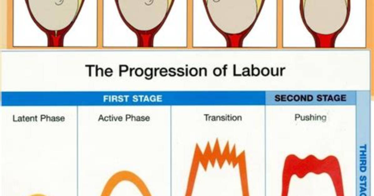 Does Prodromal Labor Shorten Active Labor?