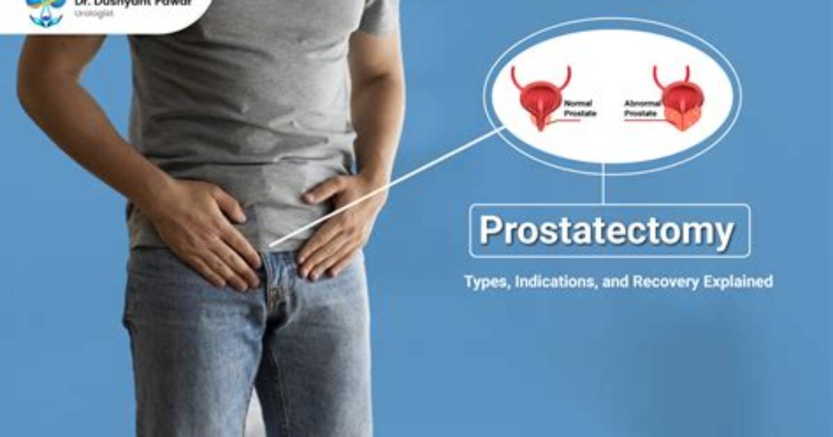 Does Prostatectomy Cause Low Testosterone?