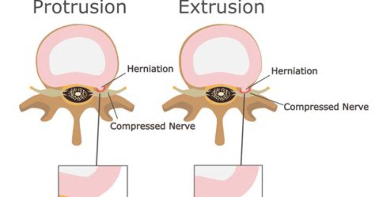 Does Protrusion Mean Herniated?