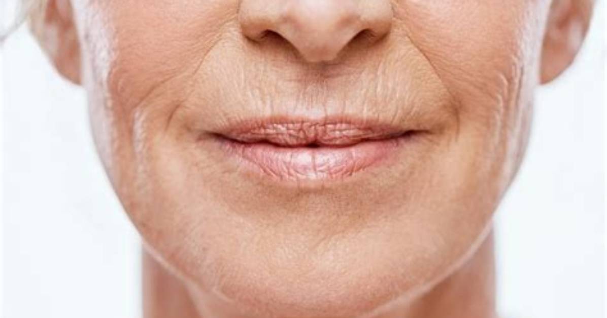 Does Puckering Lips Cause Wrinkles?