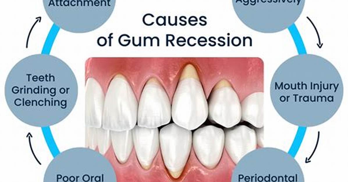Does Receding Gums Cause Tooth Loss?
