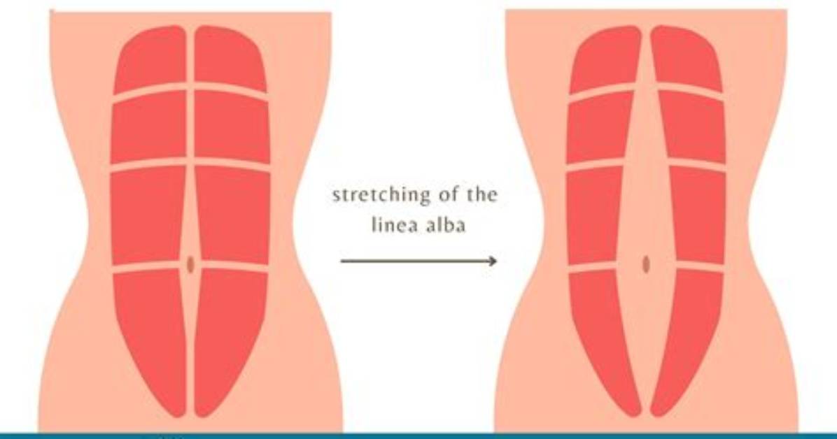Does Rectus Diastasis Heal?