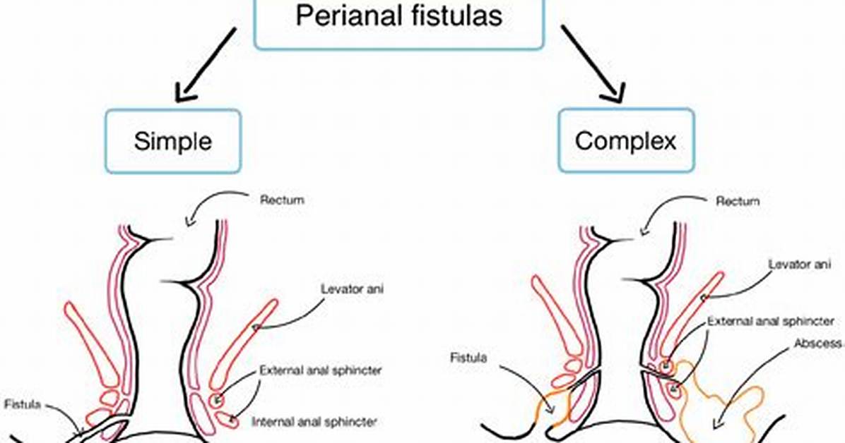 Does Remicade Heal Fistulas?