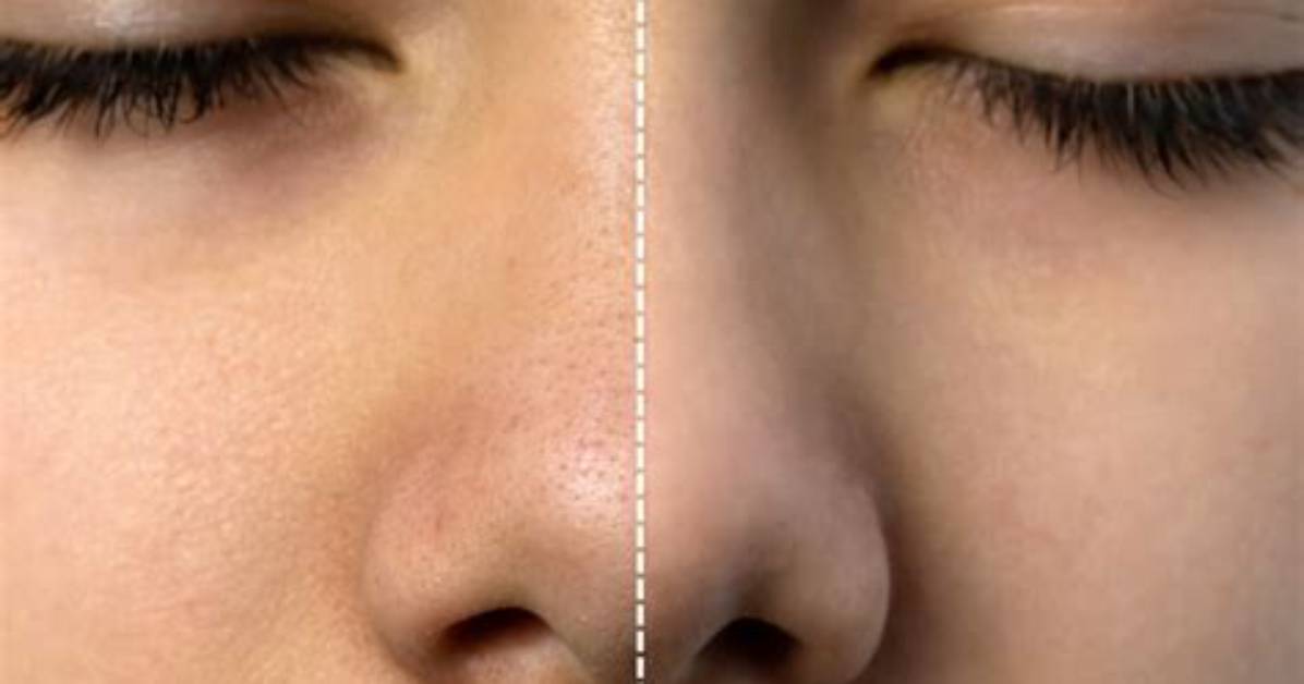 Does Retina Shrink Pores?