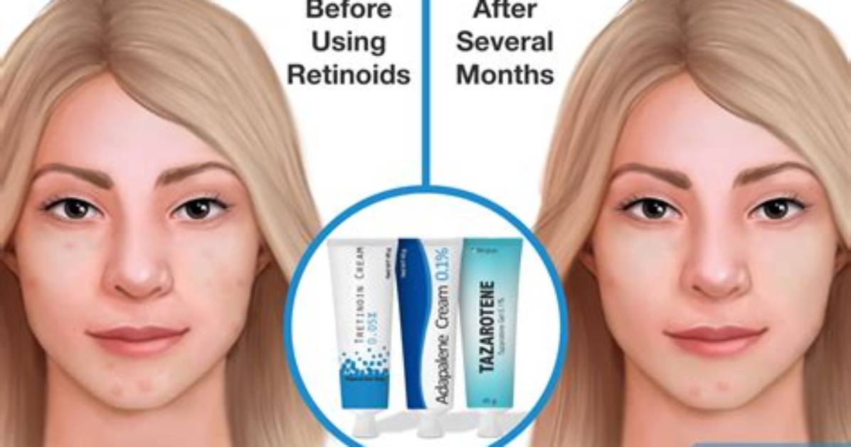 Does Retinol Help with Wrinkles?