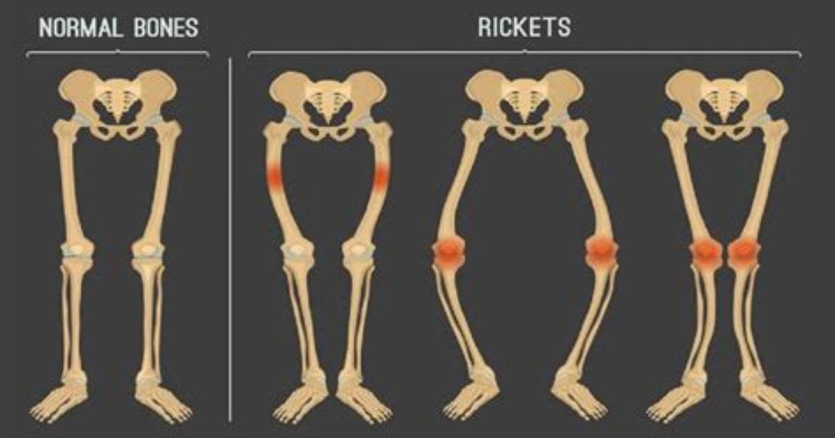 Does Rickets Have a Cure?