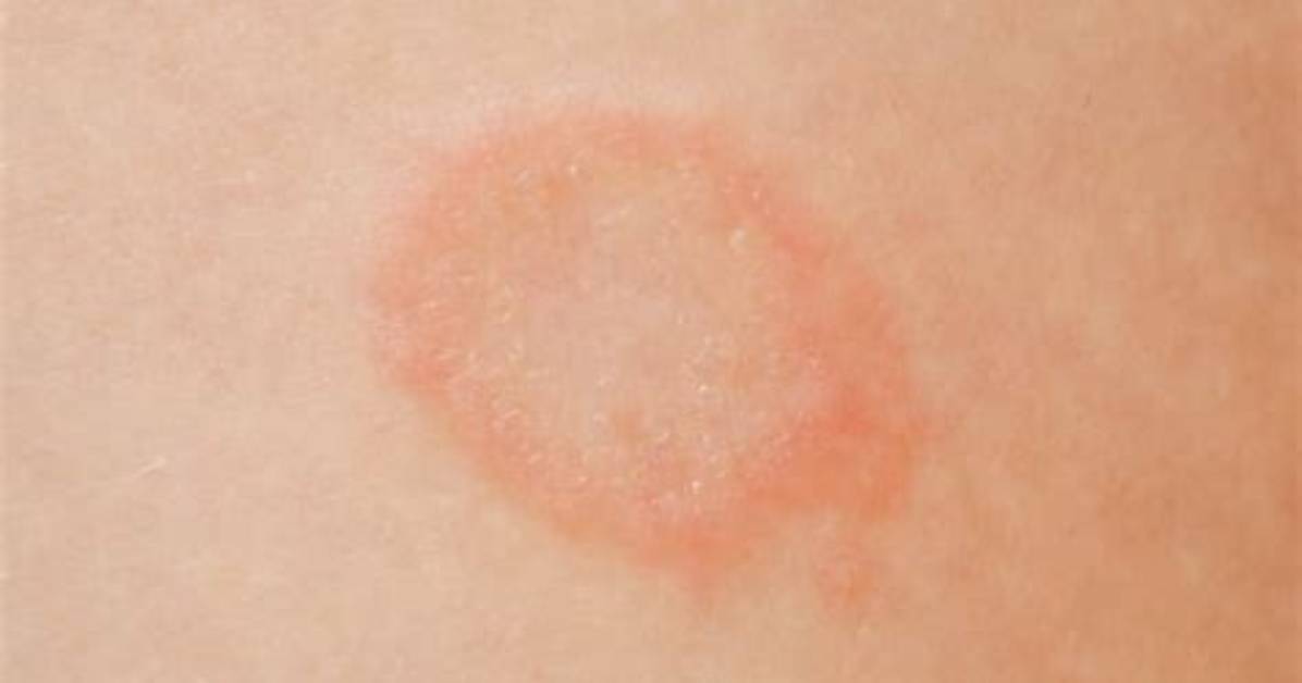 Does Ringworm Look Like a Bullseye?