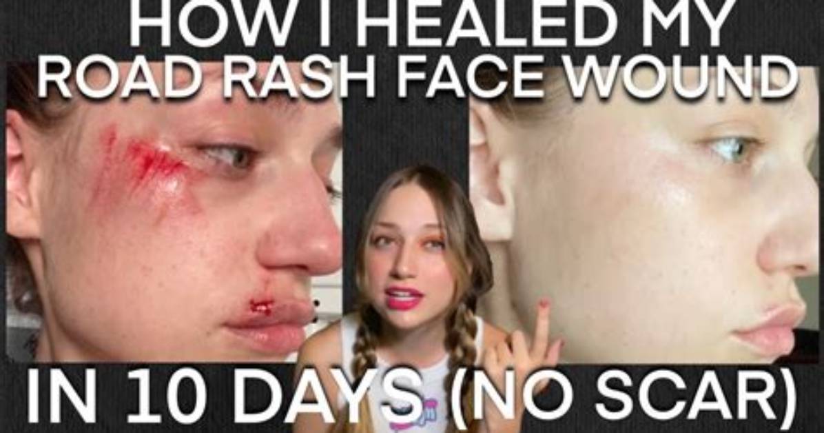 Does Road Rash Scar?