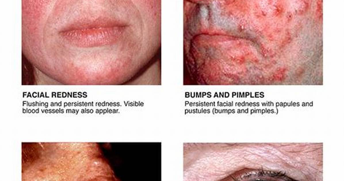 Does Rosacea Cause Pustules?