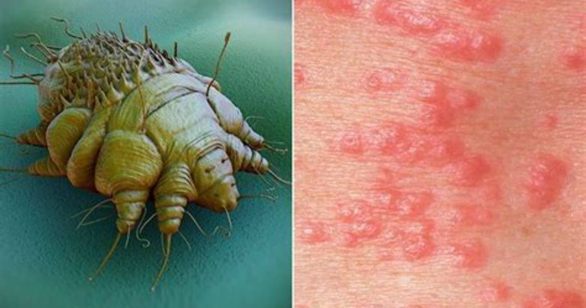 Does Scabies Cause Welts?