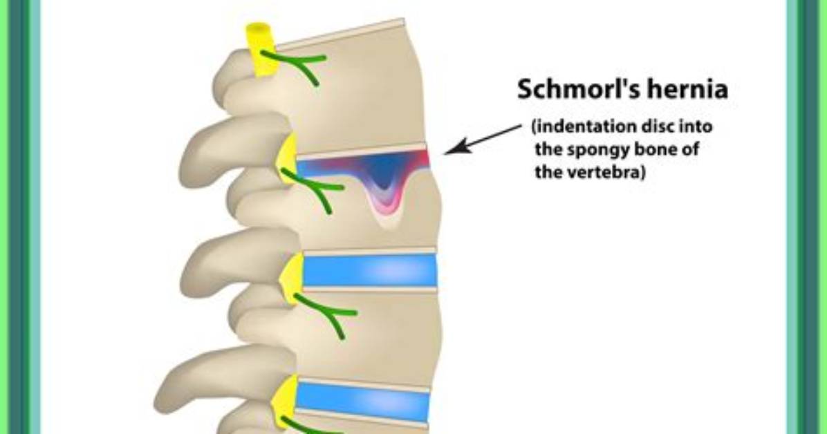 Does Schmorl's Node Cause Pain?