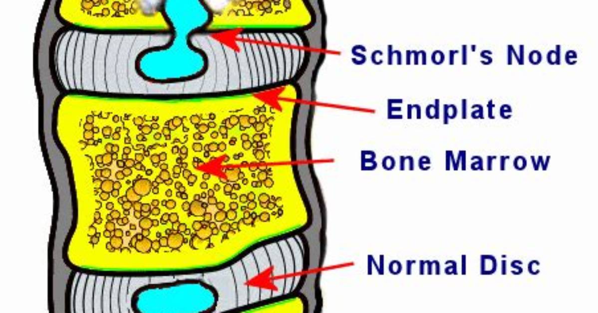 Does Schmorl's Nodes Causes Numbness?