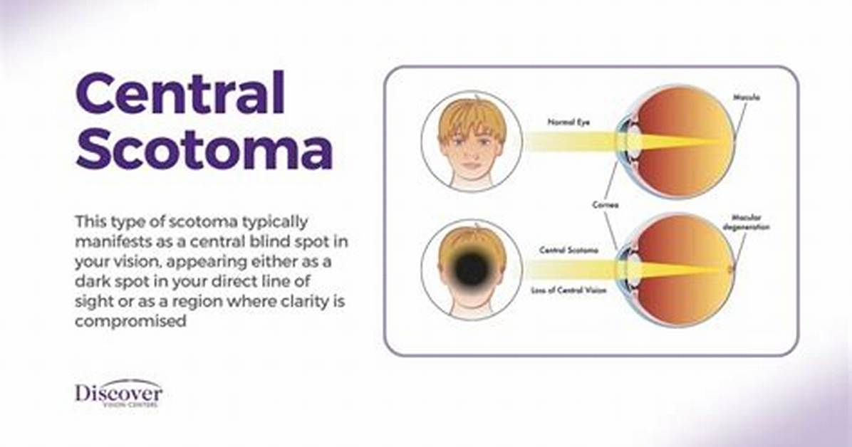 Does Scotoma Go Away?
