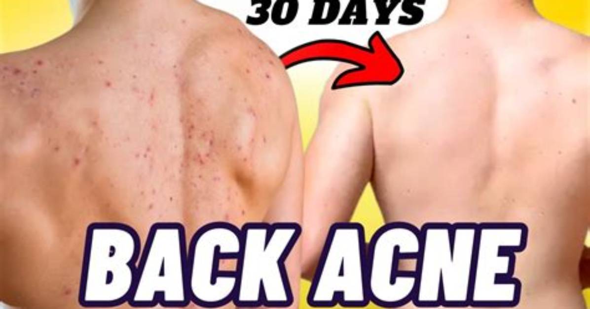 Does Scrubbing Your Back Help Acne?
