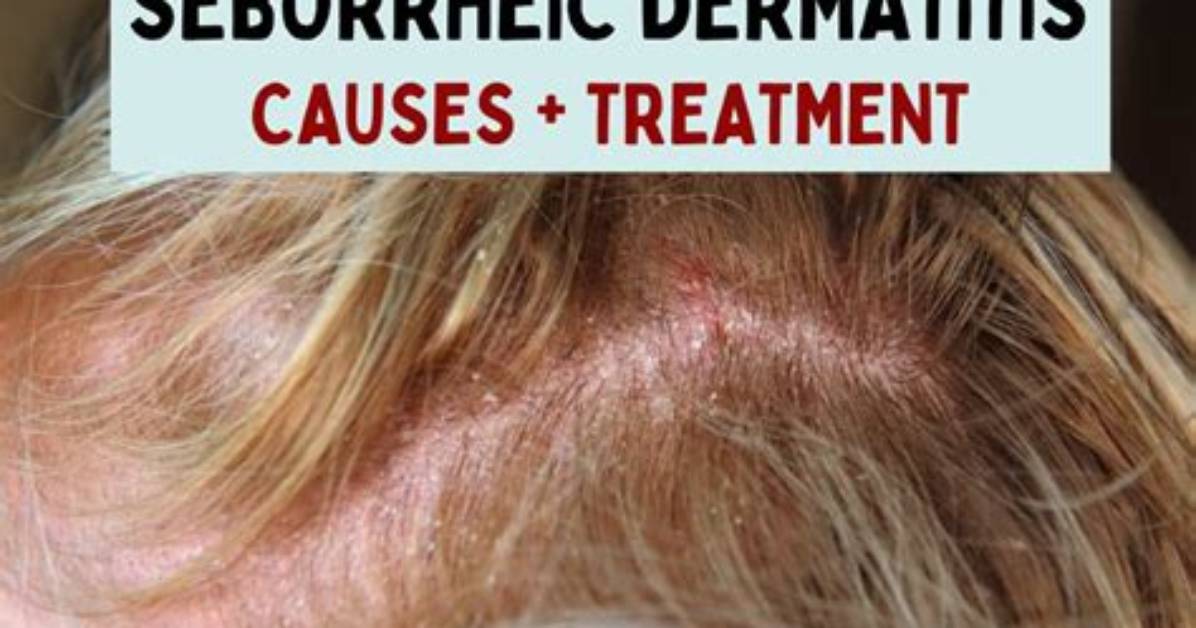Does Seborrheic Dermatitis Burn?