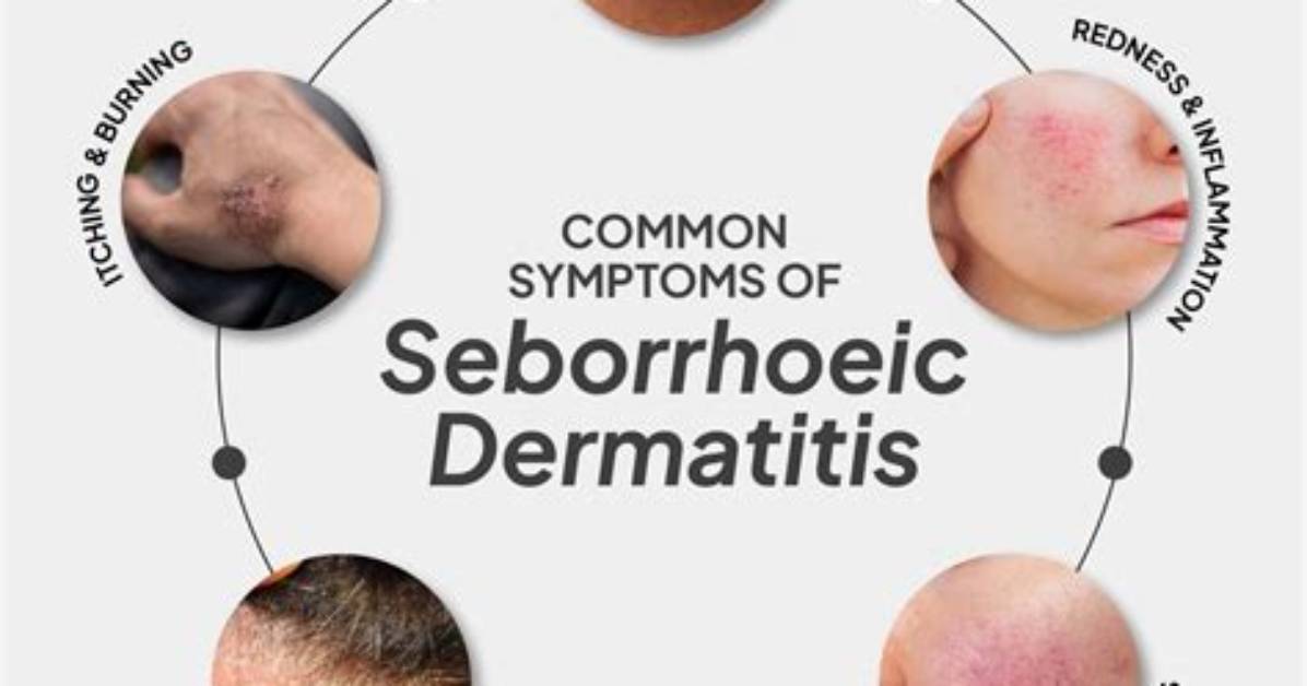 Does Seborrhoeic Dermatitis Spread?