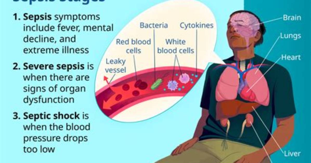 Does Sepsis Have a Smell?
