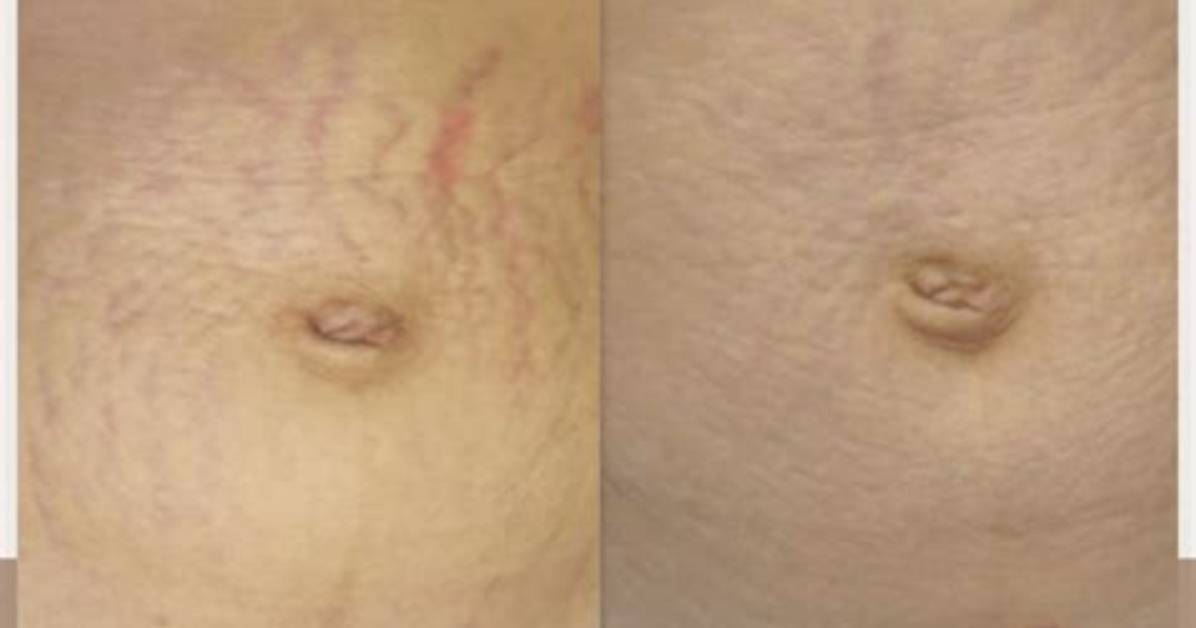 Does Serica Work on Stretch Marks?