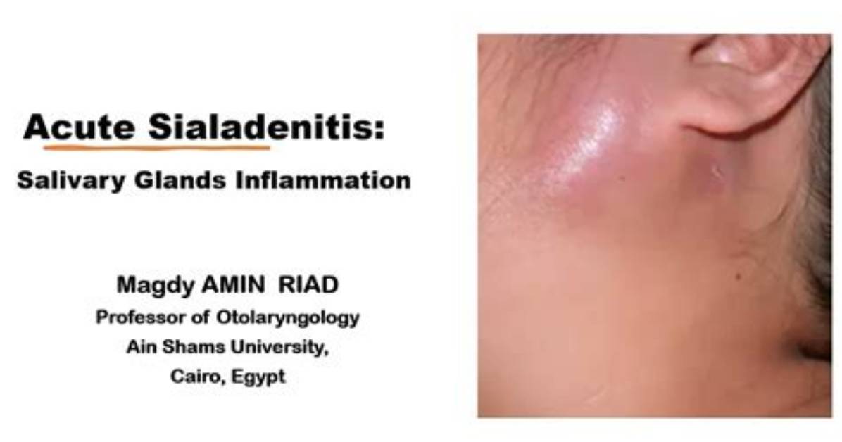 Does Sialadenitis Go Away?