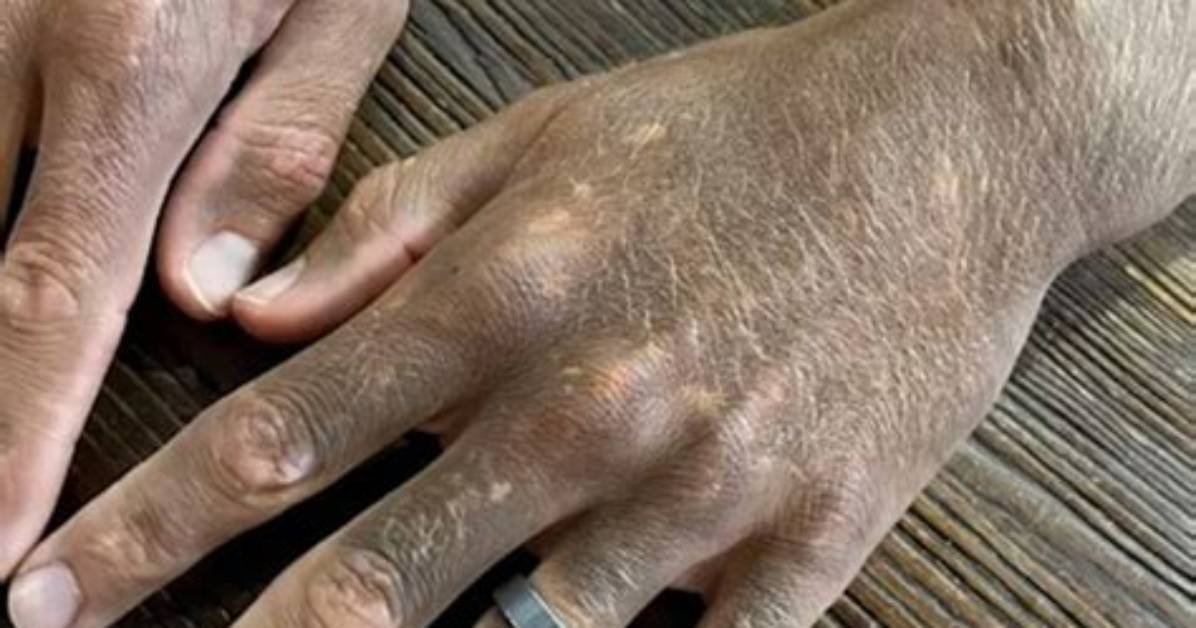Does Silvadene Turn Skin Black