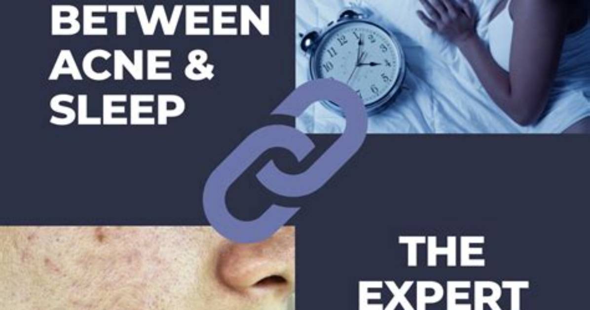Does Sleeping Help with Acne?