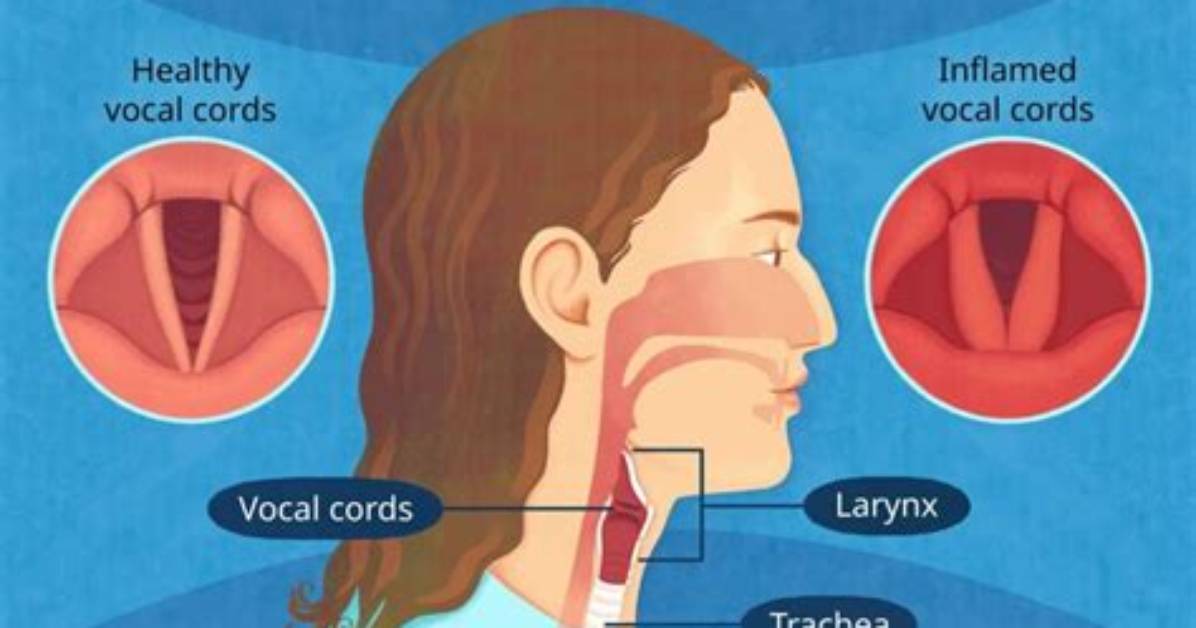 Does Smoking Cause Laryngitis?