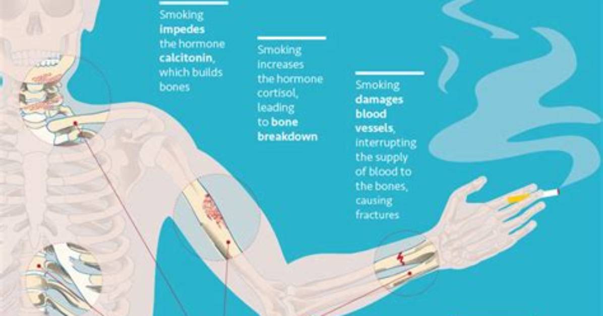 Does Smoking Cause Soft Bones?