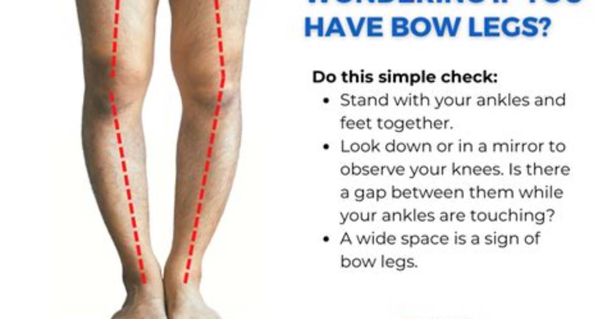 Does Soccer Make You Bow Legged?