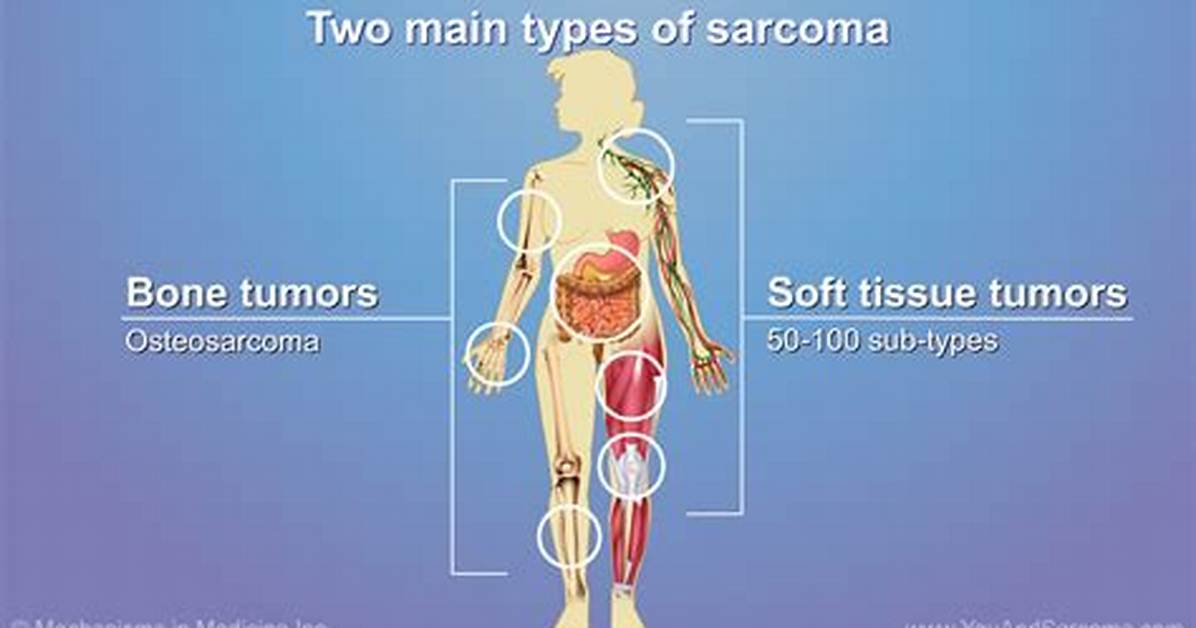 Does Soft Tissue Sarcoma Spread?