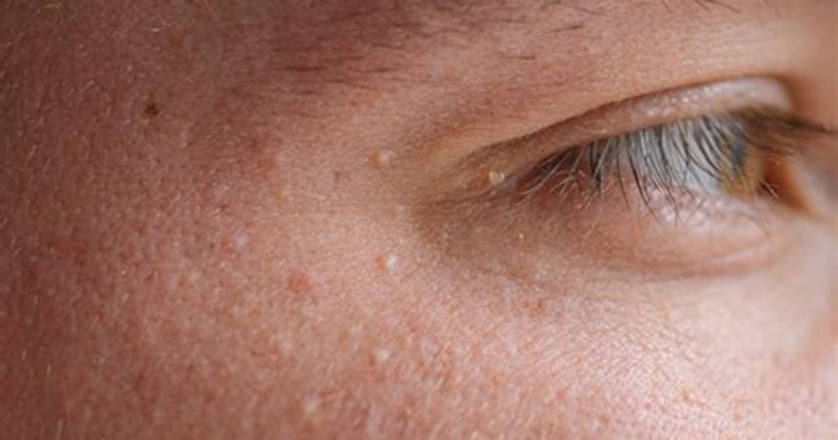 Does Squalane Cause Breakouts?