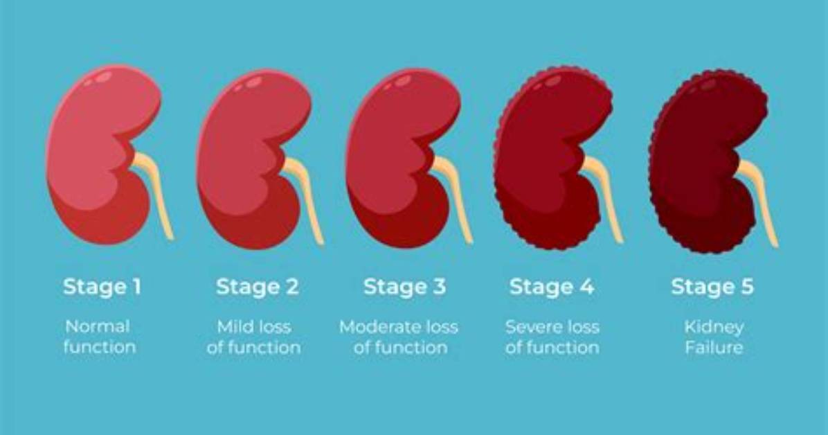 Does Stage 4 Renal Failure Qualify for Disability
