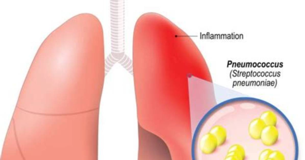 Does Streptococcus Pneumoniae Cause Pneumonia?