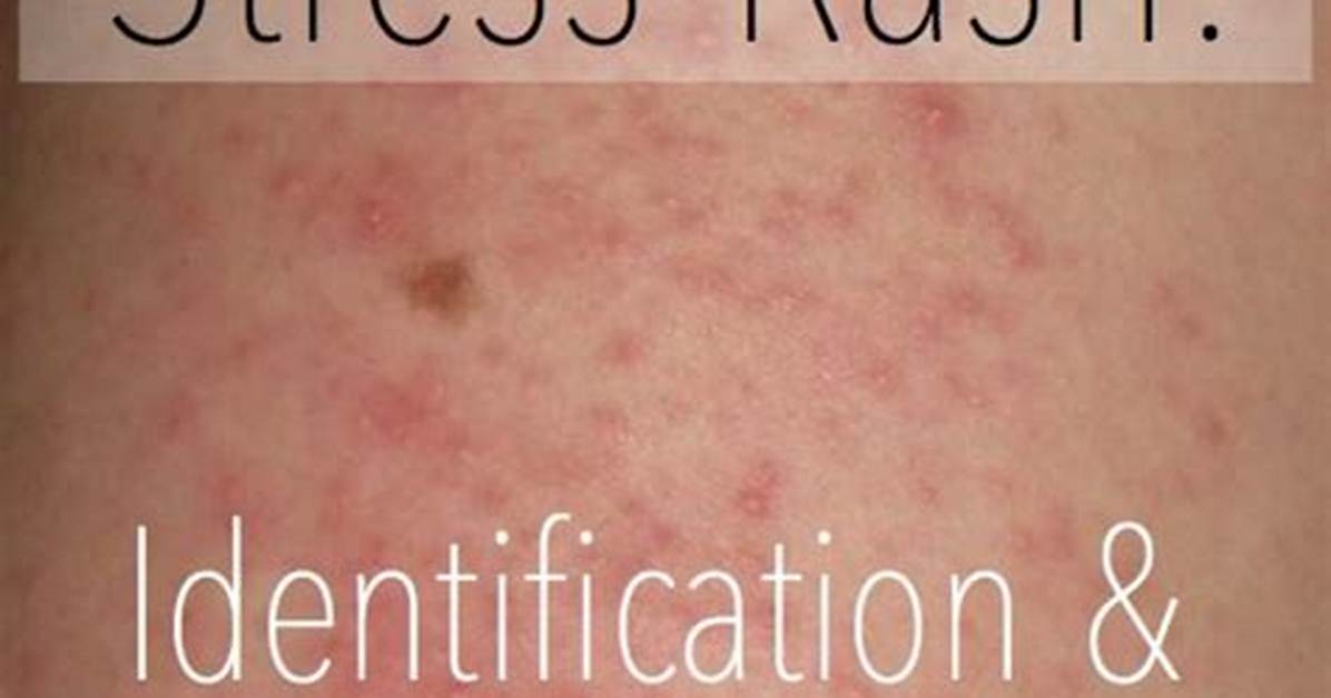 Does Stress Cause Rashes?