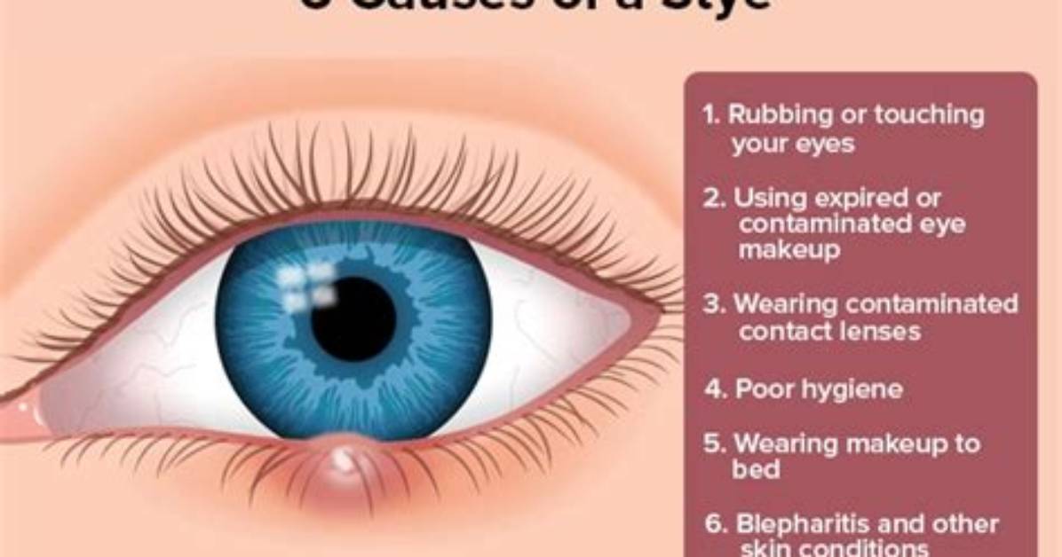 Does Stress Cause Styes?