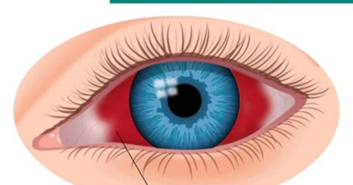 Does Subconjunctival Hemorrhages Go Away?