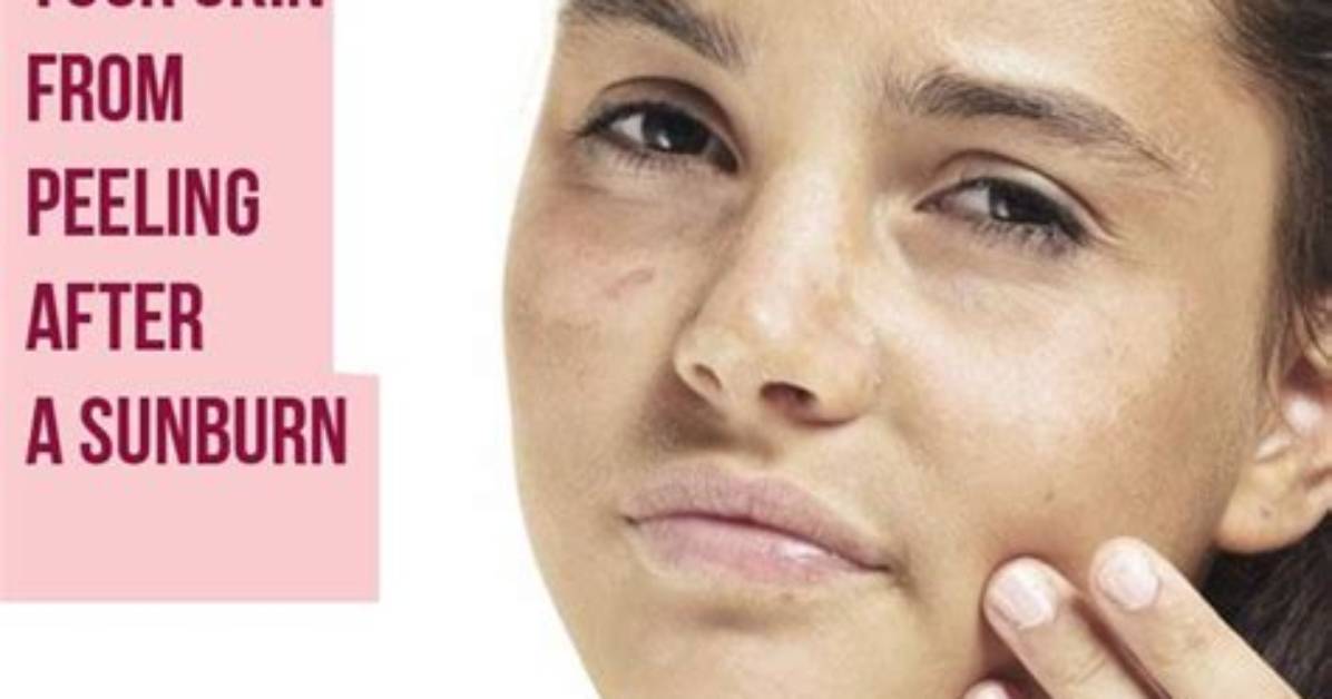 Does Sunburned Skin Always Peel?