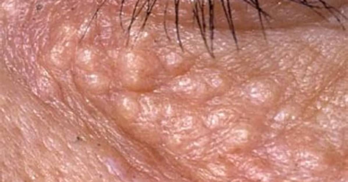 Does Syringoma Come Back?