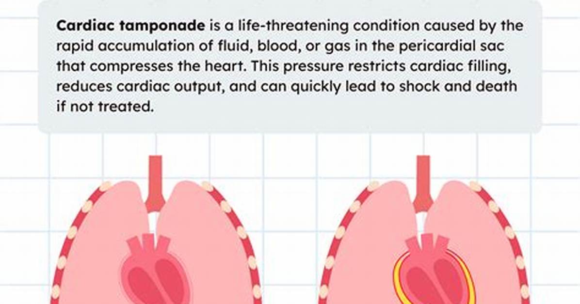 Does Tamponade Causes Pain?