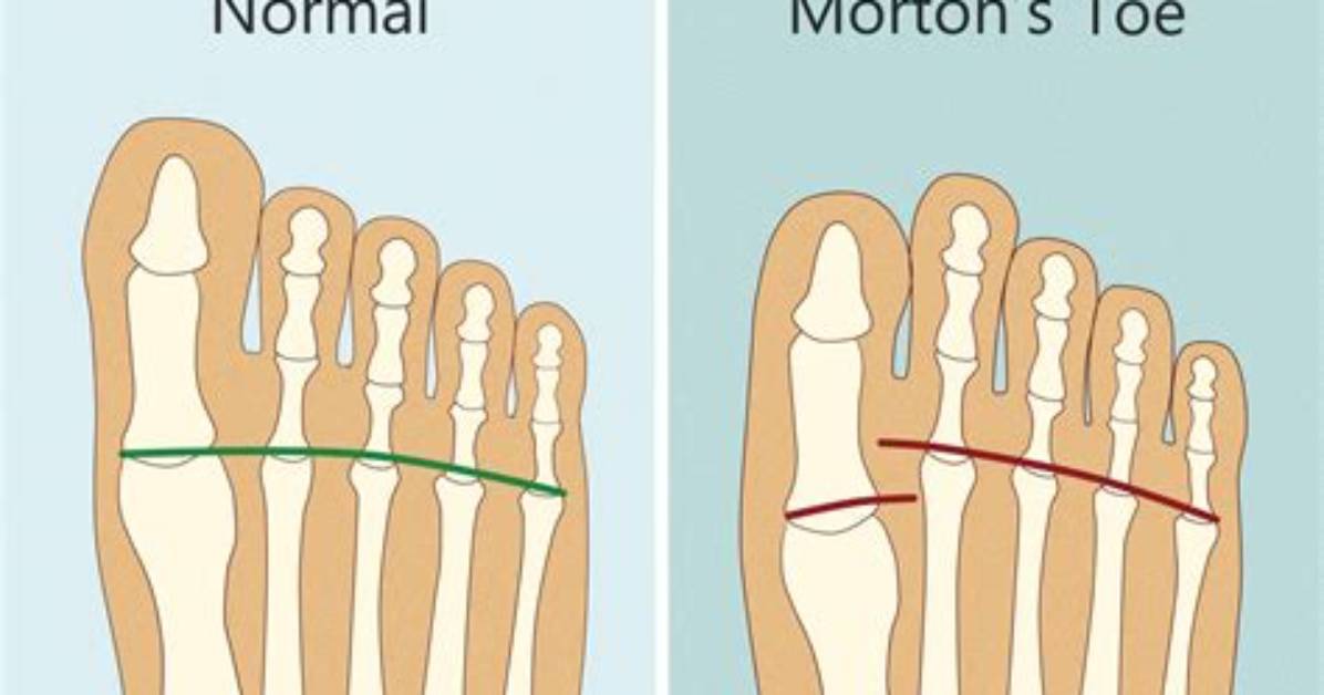 Does the Big Toe Have a Middle Phalanx?