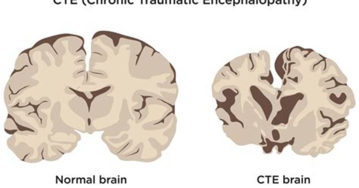 Does the Nfl Recognize Cte