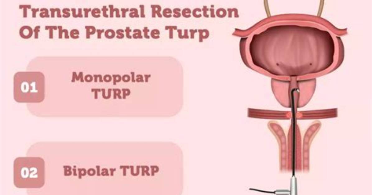 Does the Prostate Grow Back After Turp