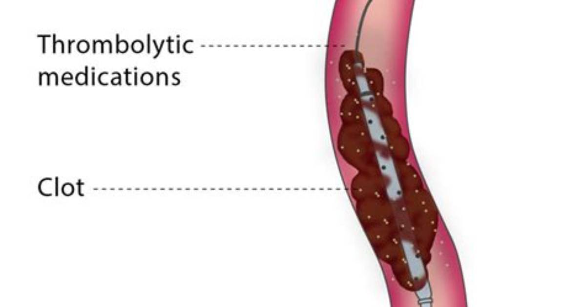 Does Thrombolysis Work for Stroke?