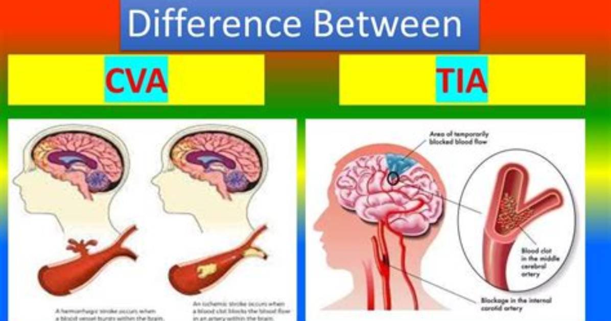 Does Tia Lead to Cva