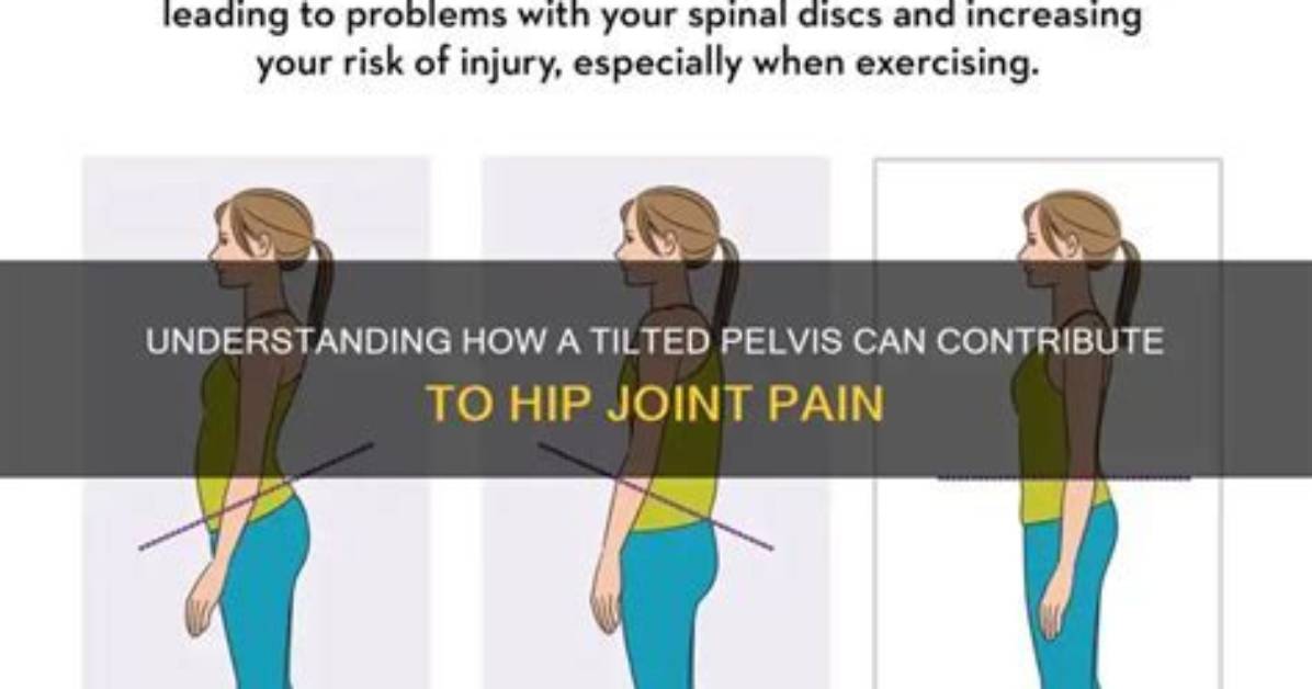 Does Tilted Uterus Cause Back Pain?