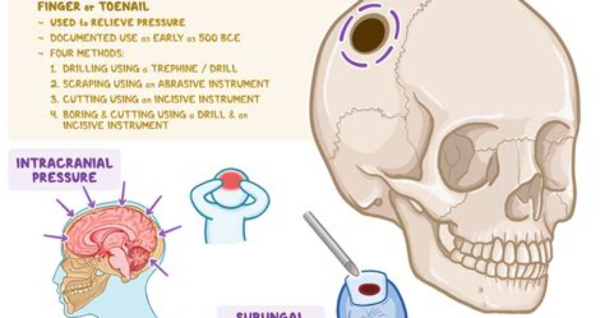 Does Trepanation Help Headaches?