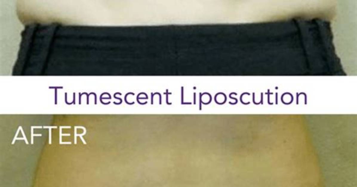 Does Tumescent Liposuction Work?