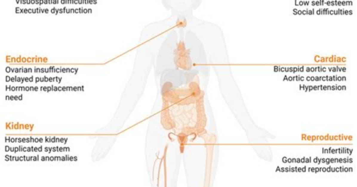 Does Turner Syndrome Affect the Brain?