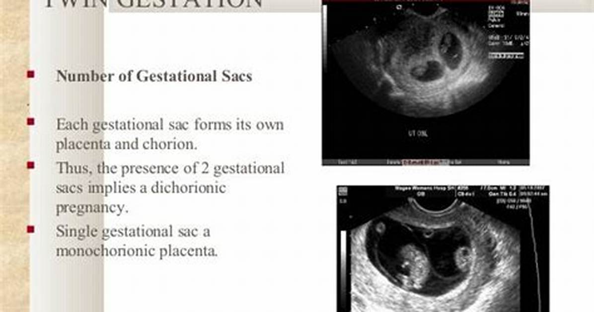 Does Two Gestational Sacs Mean Twins?