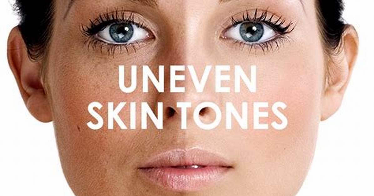 Does Uneven Skin Tone Mean?